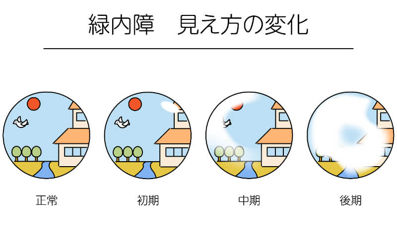 当院の緑内障治療の特長