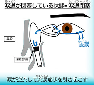 流涙症図1