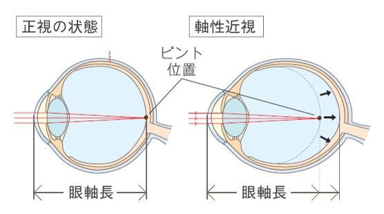 軸性近視のイラスト