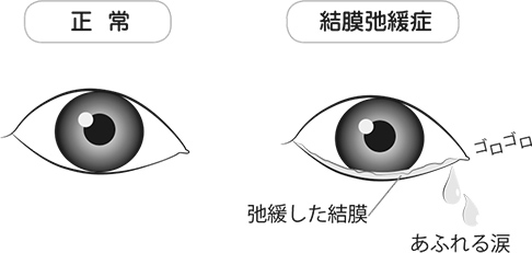 流涙症図2